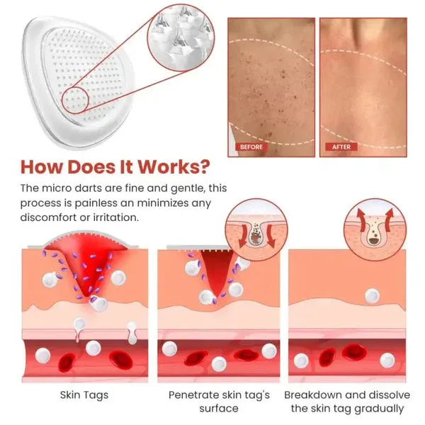 DermaSmooth Skin Tag Remover Patch – Fast, Safe, And Painless Skin Tag And Mole Removal Solution With No Scarring Or Pigmentation